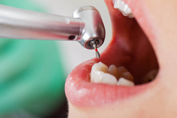 Tooth Infection Emergency Dentist in IA